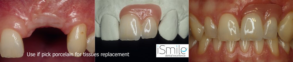 pink-ceramics-implants