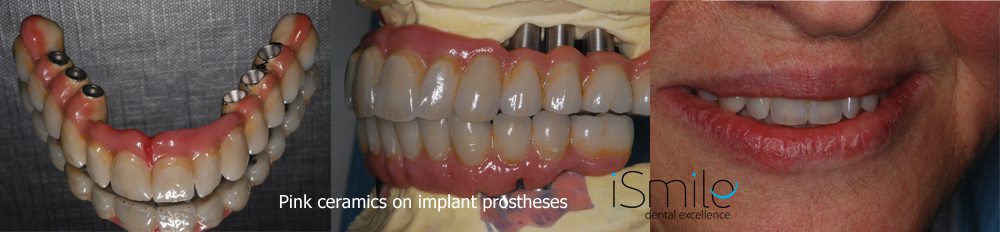 pink-ceramics-implants