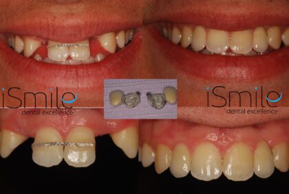 Hypodontia restored with resin bonded bridges